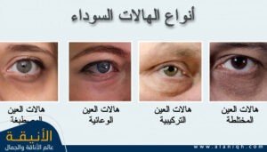 أنواع الهالات السوداء بالصور